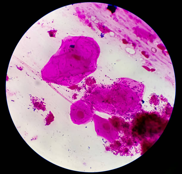 istock Epithelial cells, clue cells and Neisseria gonorrhoeae micrograph. 2161635316