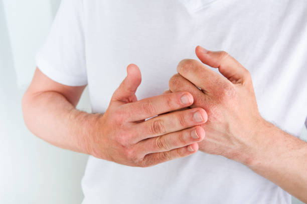 istock Man scratches or shows hands with dry, cracked skin on white backgrounds. Problem with many people - eczema on hand, allergies or dry skin. Health care concept. Close up. 2161647486