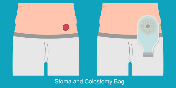 A colostomy is a surgical procedure that changes the trajectory of food waste. A colostomy is a surgical procedure that changes the trajectory of food waste through your bowels with a colostomy, you poop into a colostomy bag, vector illustration. stomach-blockage stock illustrations