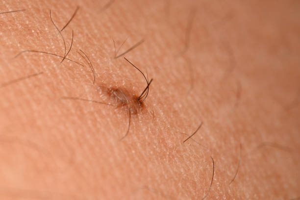 The hair growing on mole