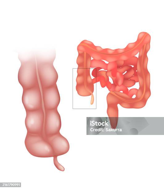 Appendix Hole The Appendix Or Appendices Appendixes Also Vermiform Appendix Human ...