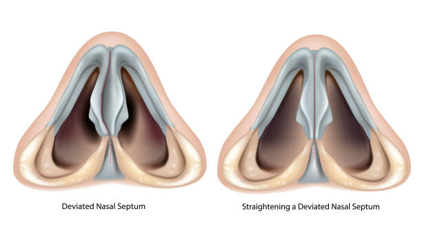 Deviated nasal septum and Straightening a Deviated Nasal Septum. Deviated nasal septum and Straightening a Deviated Nasal Septum. Septoplasty and Rhinoplasty septum stock illustrations