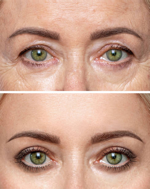 istock Woman's eyes before and after rejuvenation procedures. 2161976961