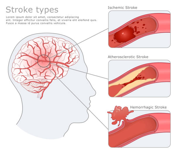 ilustraciones, imágenes clip art, dibujos animados e iconos de stock de tipos de ilustración médica de ictus - derrame cerebral