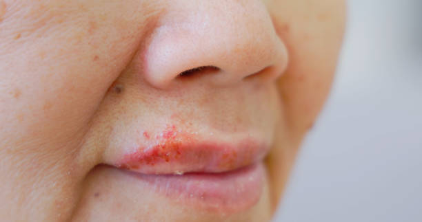 Labial Problems 180+ Herpes Labial Mulher fotos de stock, imagens e fotos royalty-free ...