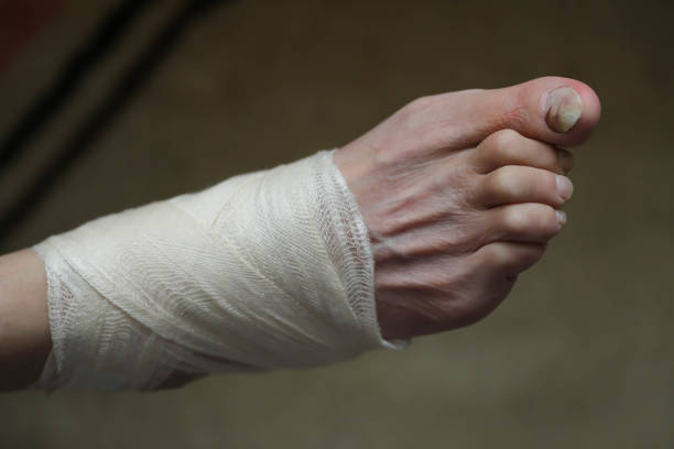 The wound was caused by a fall. The old man has a wound on his foot. Foot in a bandage.