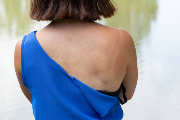 Woman wearing blue top showing painful sunburn on back standing in front of water