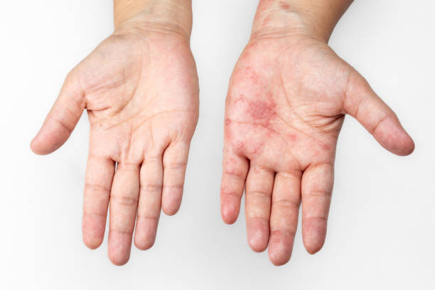 pásový opar, zoster nebo herpes zoster příznaky na paži. - ganglion - stock snímky, obrázky a fotky