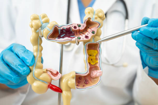 istock Ulcerative Colitis. Intestine, appendix and digestive system, doctor holding anatomy model for study diagnosis and treatment in hospital. 2162320201
