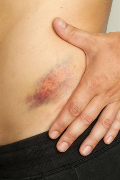istock Close up view of a nasty bruise 2162368930