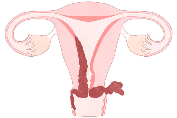 prázdný rakovina endometria (rakovina dělohy) diagram stadia 3b - endometritida ilustrace stock ilustrace
