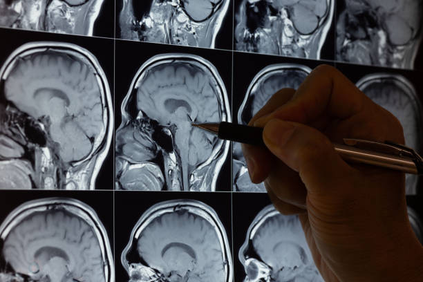 istock Doctor Analyzing Brain MRI Scans with Pen 2162392592