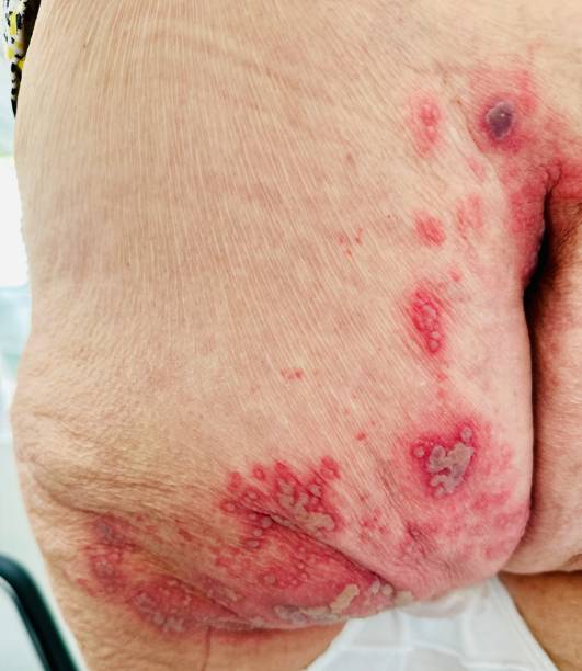 istock severe shingles infection herpes zoster 2162446820