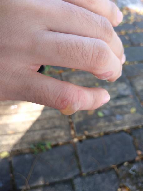istock My hands were blistered from being hit by a lot of dough while cooking 2162452736