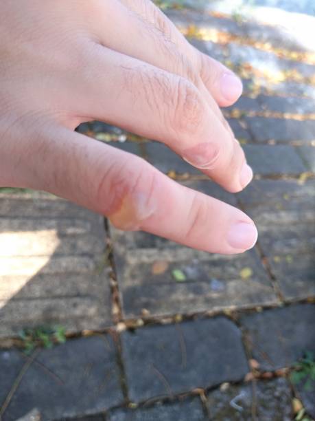 istock My hands were blistered from being hit by a lot of dough while cooking 2162452737