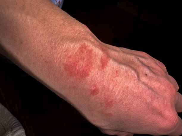 istock Skin Concern: Visible Red Patches on the Hand 2162639704