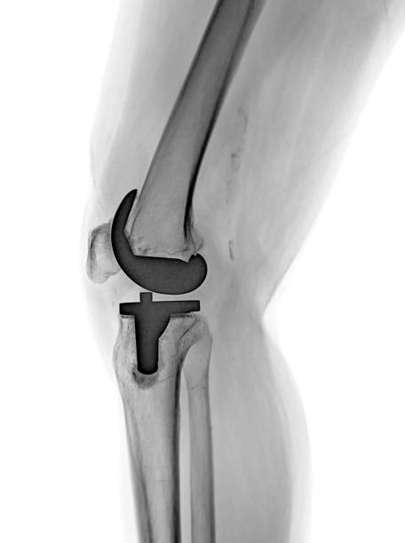 istock X-ray image of knee joint Lateral view reveals Knee Replacement. 2162900526