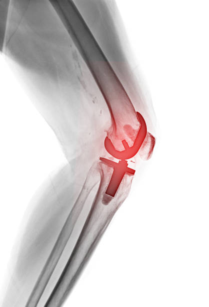 istock X-ray image of knee joint Lateral view reveals Knee Replacement. 2162900534