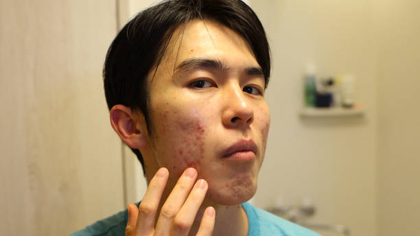 istock Asian man got an Acne 2163164996