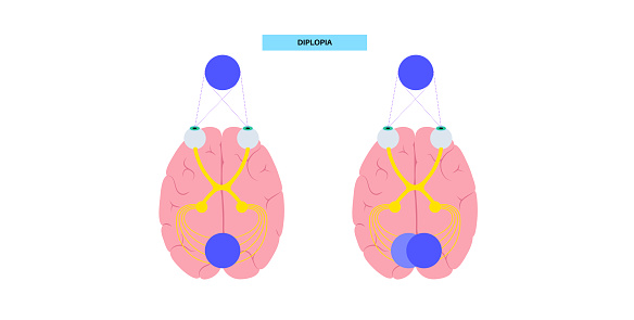 Diplopia Types Diplopia Medical Poster Stock Illustration - Download Image Now ...