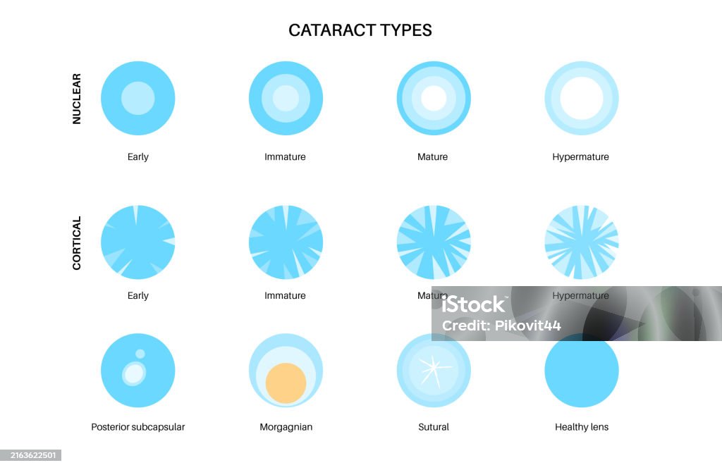 Ophthalmology Types Cataract Eye Disease Stock Illustration - Download Image Now - Aging ...
