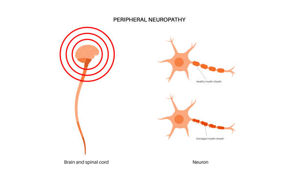 Peripheral neuropathy medical poster Peripheral neuropathy poster. Human brain and nerve fiber with a damaged myelin sheath, revealing gaps. Affected areas, indicating impaired signal transmission, pain and weakness vector illustration medulla stock illustrations