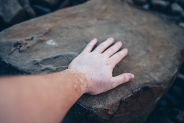 Man's hand with vitiligo stock photo