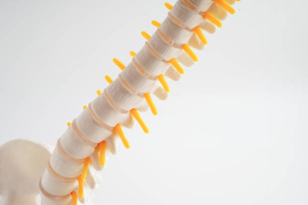 istock Spinal nerve and bone, Lumbar spine displaced herniated disc fragment, Model for treatment medical in the orthopedic department. 2163763350