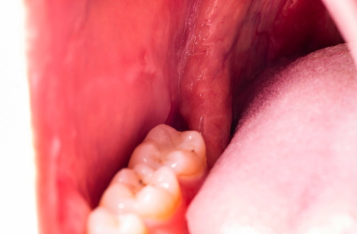 Complex Wisdom Tooth Recess After Complex Impacted Wisdom Tooth Extraction Traumatic Healing ...