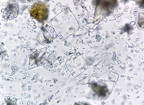istock Uric acid crystals and calcium oxalate monohydrate under microscope 2163931616