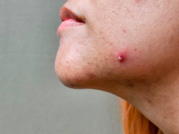 istock Pustular acne with pus on the face and cheeks of an Asian woman 2164000607