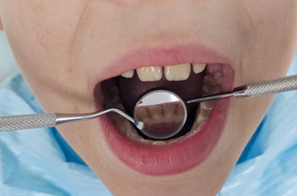 dentist uses a special instrument to restore a tooth. Dental care and care