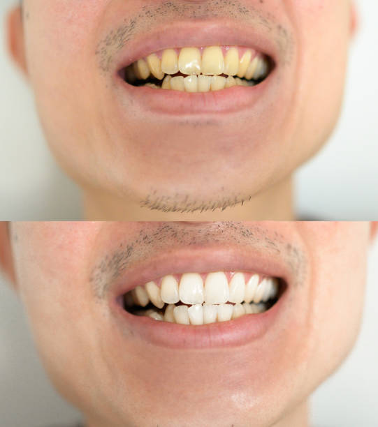 istock Before / after Teeth whitening or Tooth bleaching in asian guy 2164151761