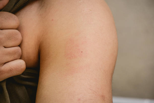 istock Allergy mark and redness, itching on a man's arm. Allergic reaction to nicotine patch 2164179822