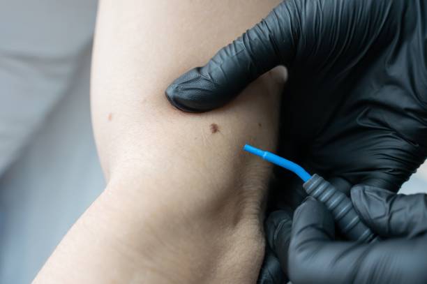 istock Dermatologist removes a mole on a patient's arm using an electrocoagulator. 2164405197