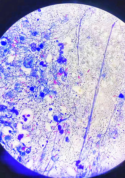 Microscopic morphology of Ziehl-Neelson staining of Mycobacterium species. Mycobacterium pus  sample. Microscopic view. Ziehl Neelsen stain.