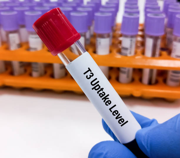 istock Blood sample for T3 resin uptake(T3RU) test. Thyroid function tests to diagnosis of hyperthyroidism or hypothyroidism of a patient. 2165099123