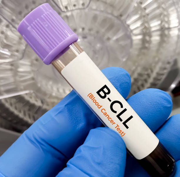 istock Blood sample for Beta cell chronic lymphocytic leukemia (B cell CLL) Chronic Lymphoblastic Leukemia (CLL) blood test. Blood cancer. 2165100774
