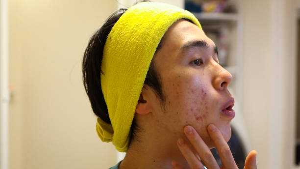 istock Asian man got an Acne 2165496453