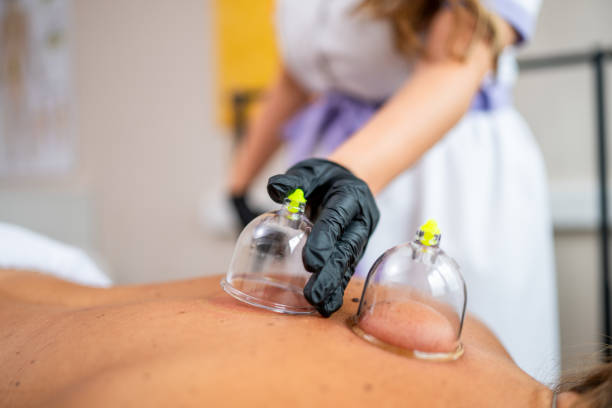 istock Vacuum cupping body treatment 2165521070
