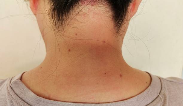 istock The mole on the body. 2165539407