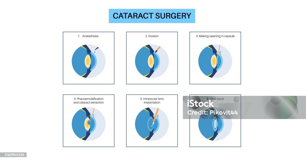 Cataract Incision Closure Cataract Surgery Poster Stock Illustration - Download Image Now - Aging ...