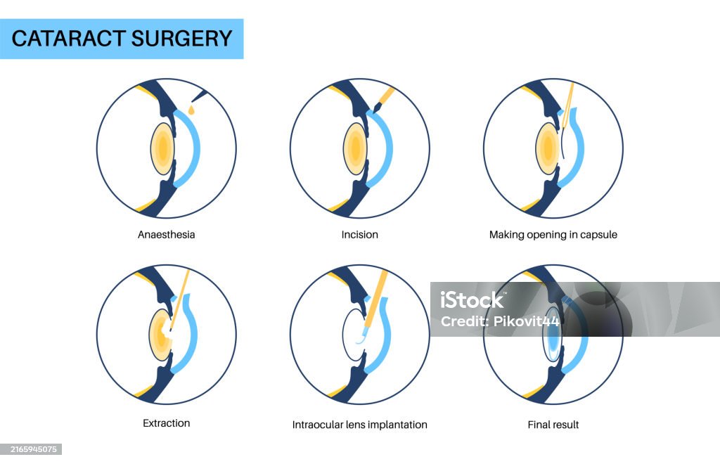 Cataract Incision Closure Cataract Surgery Poster Stock Illustration - Download Image Now - Aging ...