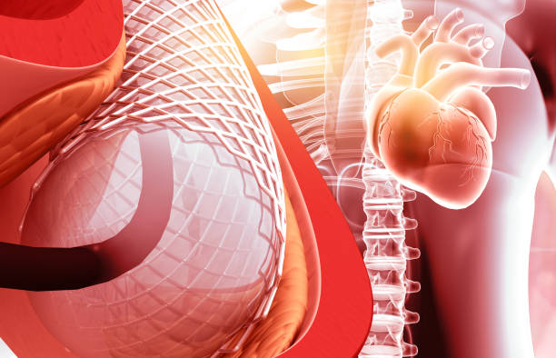 istock Stent implantation concept, human heart 2166435245
