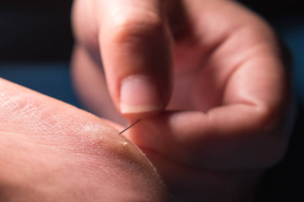 istock Women's fingers pierce a callus on the heel with a needle 2166675863