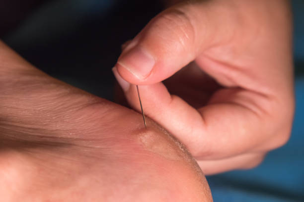 istock Women's fingers pierce a callus on the heel with a needle 2166675868