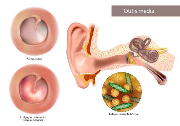 70 Otitis Media Ilustra o De Stock Gr ficos Vetoriais E Clipart 70-otitis-media-ilustra-o-de-stock-gr-ficos-vetoriais-e-clipart