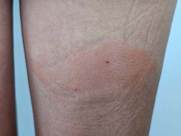 istock Skin rash on the knee area observed during daylight hours 2167037747