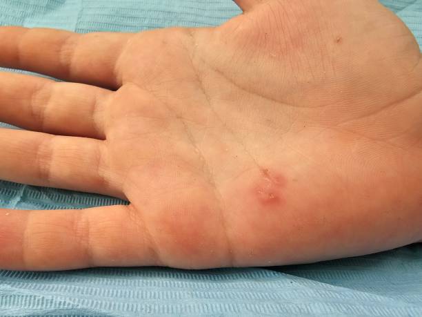 istock Red bump on the palm of a hand while on a blue surgical table in a clinical setting 2167037771