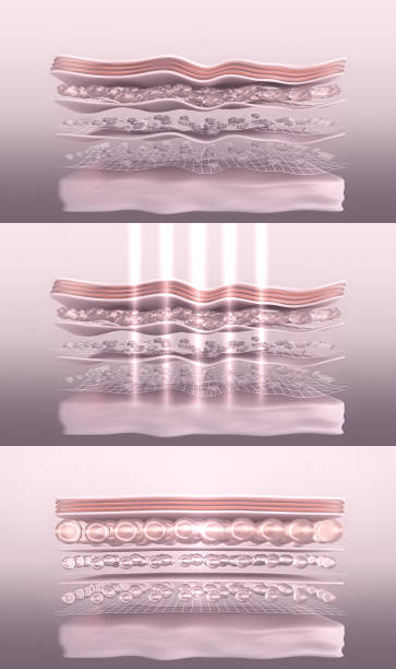 Skin before and after laser collagen-boosting therapy